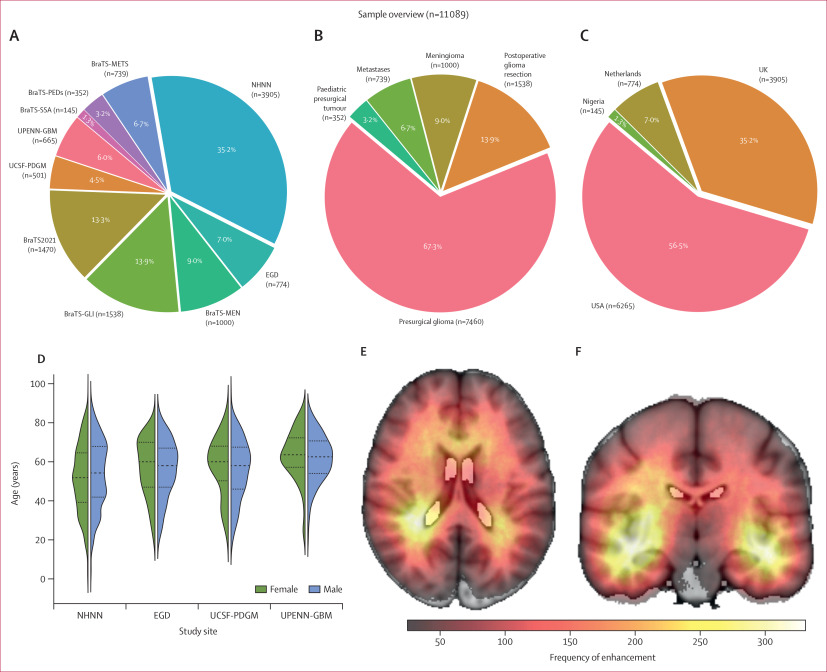 Brain tumour enhancement prediction from non-contrast MRI thumbnail