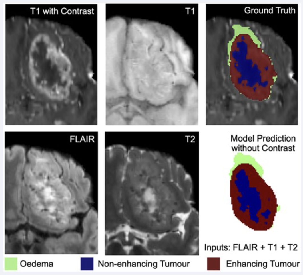 Brain tumour segmentation with incomplete MRI data thumbnail